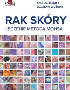 Rak skóry. Leczenie metodą Mohsa